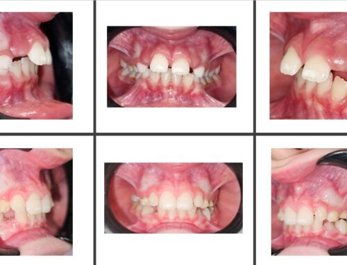 Trattamento ortodontico con Invisalign First