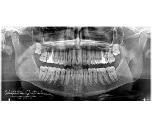 Estrazione denti del giudizio