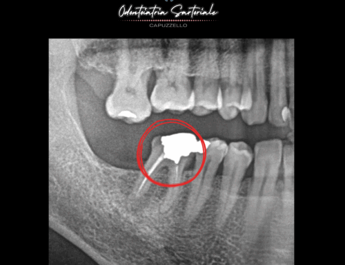 Ritrattamento endodontico su molare inferiore