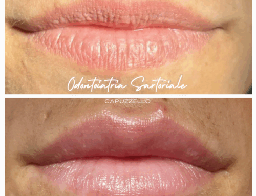 Labbra ridefinite, profilo in armonia.