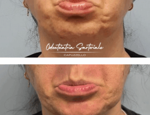 Botox per restituire al viso freschezza e armonia