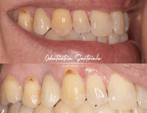 Quando un dente si frattura, per fortuna si può rimediare!