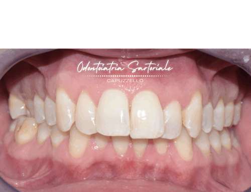 Dente compromesso o possibilità?