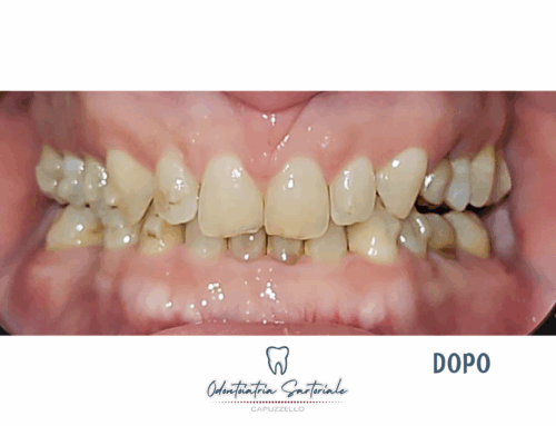 Riabilitazione implantare e della chiusura del diastema centrale