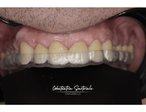 Quando il bite non è un optional