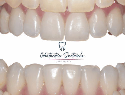 Sbiancamento domiciliare