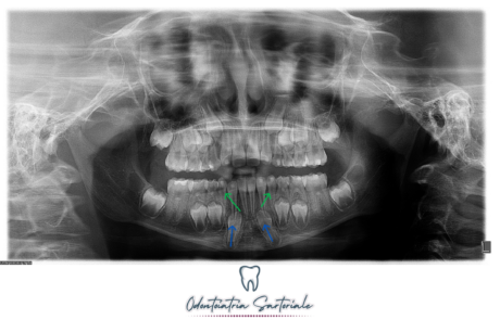 radiografia denti
