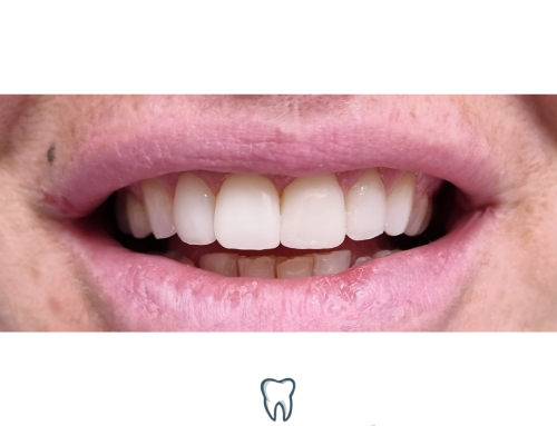 Le faccette dentali non sono solo questione di estetica.