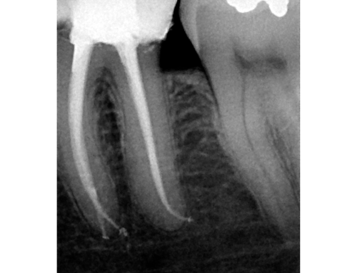 Un dente già devitalizzato può sviluppare una nuova infezione.